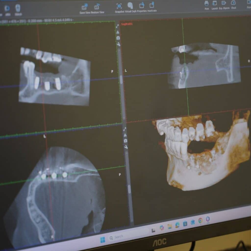 Dental CBCT scan showing multiple jaw X-ray views on monitor